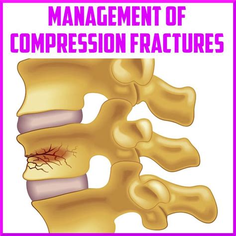 vertebral compression fracture diagnostic test|vertebral compression fracture prognosis.